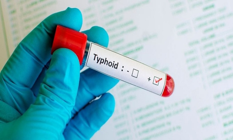 What Do Typhoid IgG And IgM Positive Mean In Tests 